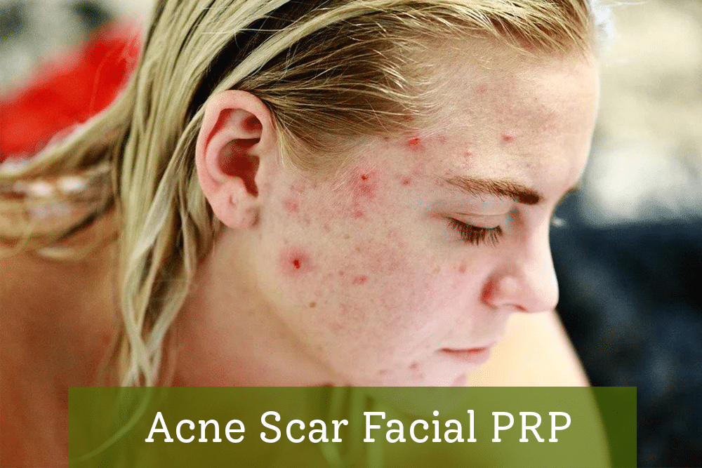 Acne Scar Facial PRP