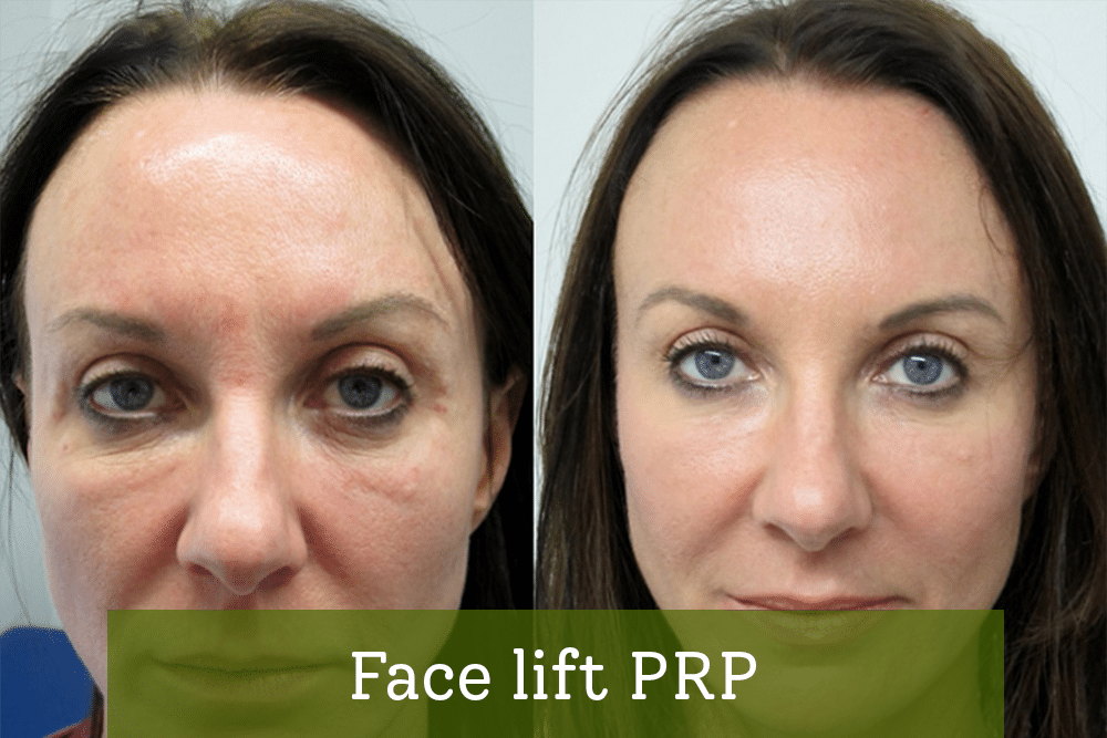 Face lift PRP