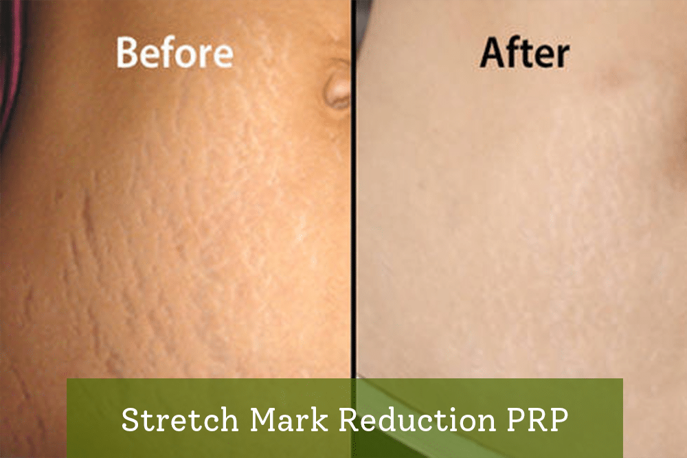 Stretch Mark Reduction PRP