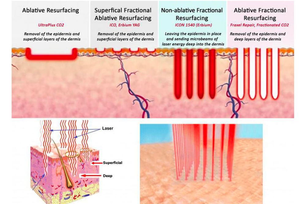 1540-laser-treatment-3-sessions